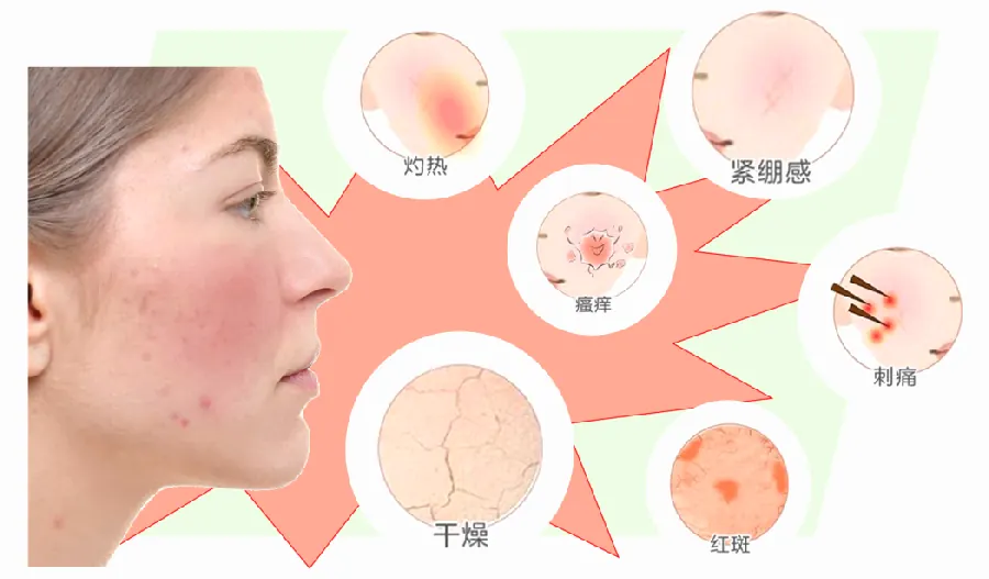 眼周脂肪粒与干纹：眼周护理示意图
